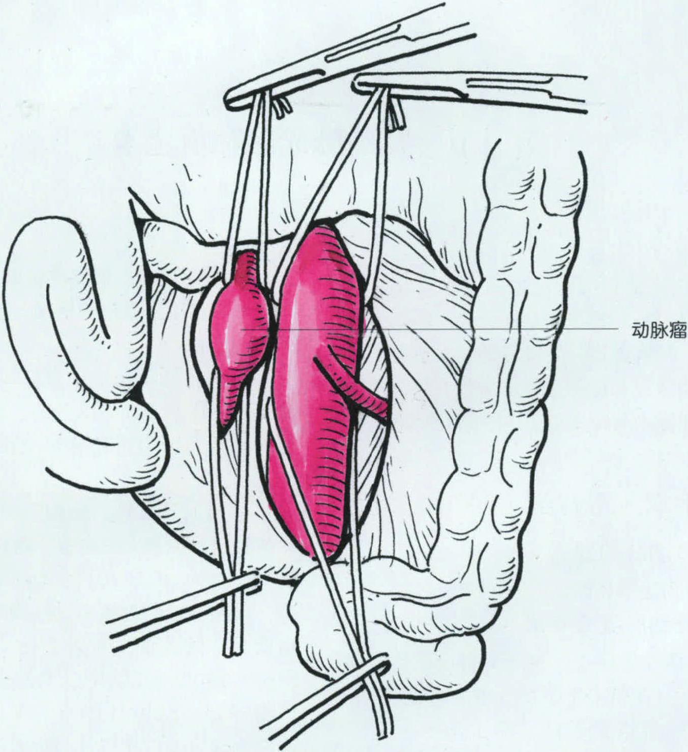 內(nèi)臟動脈瘤的治療